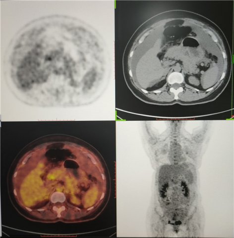 大妈疫情忍腹痛，就诊查出大端倪