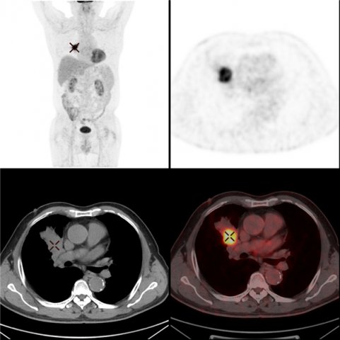 多种手段寻找肺部病灶顽凶 中大医院PET-CT显神威